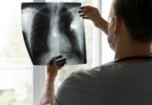 Luz verde a fármaco contra el cáncer de pulmón que reduce un 76% las recaídas frente a la quimioterapia